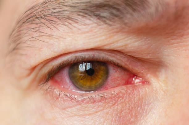 Viêm kết mạc có phải đau mắt đỏ không?