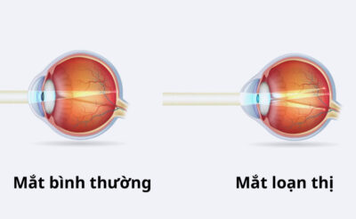 Nguyên nhân loạn thị trên trẻ nhỏ. Làm sao để phòng tránh loạn thị 