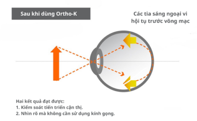 Kính Ortho-K có thật sự hiệu quả để kiểm soát cận thị?