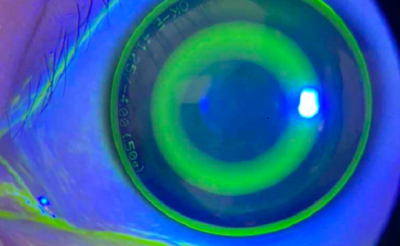 Điều trị cận thị bằng kính tiếp xúc Ortho-K