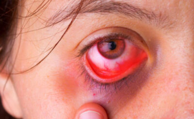Biểu hiện của đau mắt đỏ trở nặng do dùng sai thuốc
