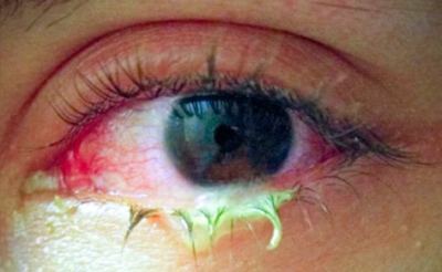 5 triệu chứng của đau mắt đỏ báo hiệu bệnh trở nặng cần đi khám ngay!