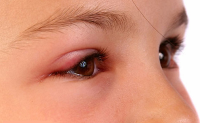 Ngứa mi mắt – dấu hiệu cảnh báo bệnh tại mi mắt