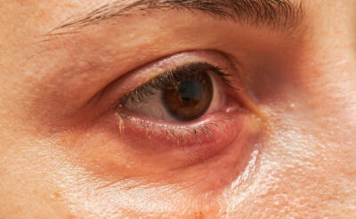 4 giai đoạn của viêm mí mắt dưới: Bạn đang ở giai đoạn nào?