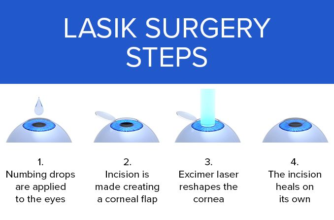 Phương pháp phẫu thuật Lasik