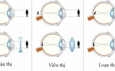 Phân biệt cận thị viễn thị loạn thị bằng đo khúc xạ
