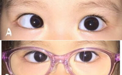 Nhược thị và lác mắt khác nhau như thế nào? Cách phân biệt