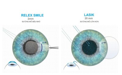 Tìm hiểu về các phương pháp điều trị mắt cận bằng laser