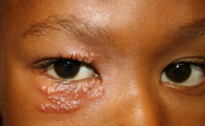 Đỏ và rát mi mắt là dấu hiệu viêm bờ mi hay zona