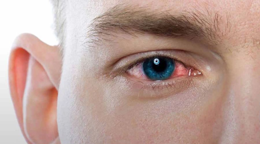 Bụi là một trong những dị vật mắt thường gặp phải