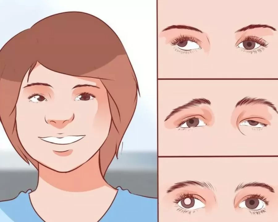 Mắt luôn ở tư thế lệch