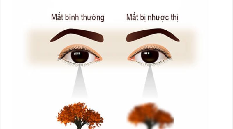 Mắt bị nhược thị