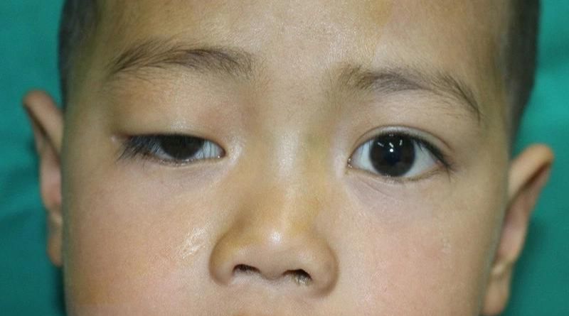 Nhược thị ở trẻ em do sụp mí